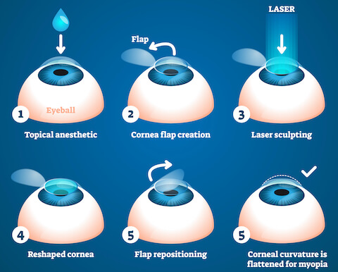 LASIK Steps Diagram