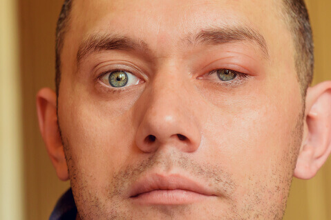 Man with blepharitis in one eye