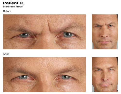 Botox® Before and After