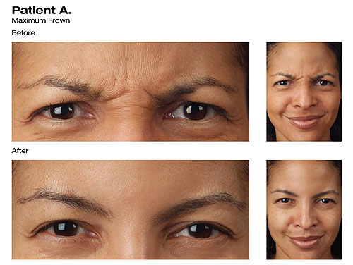 Botox® Before and After
