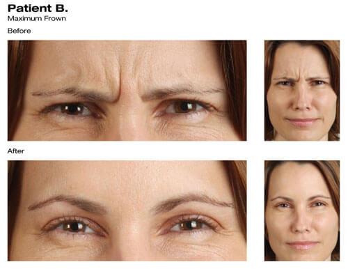 Botox® Before and After