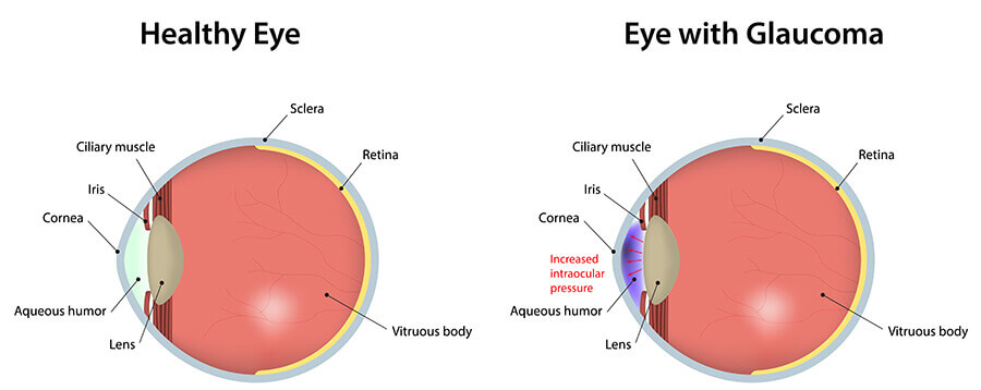 Healthy Eye vs Eye with Glaucoma