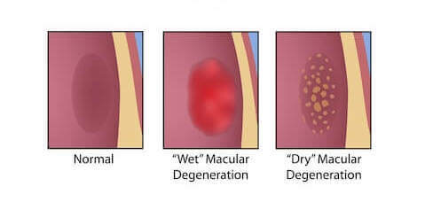 Diagram of Macular Degeneration